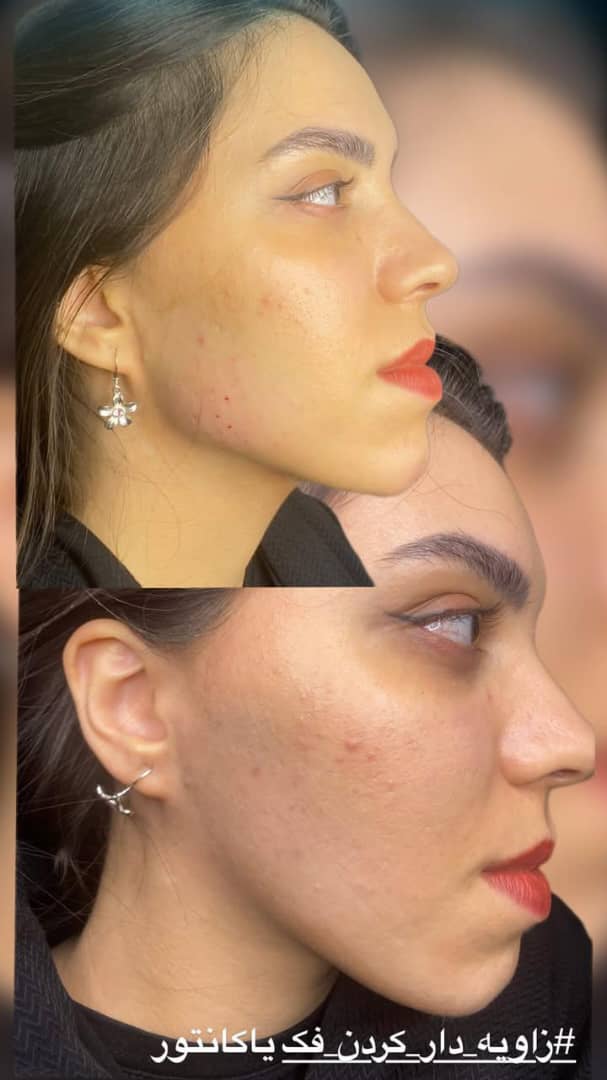 تزریق فیلر و بوتاکس در اسلامشهر 