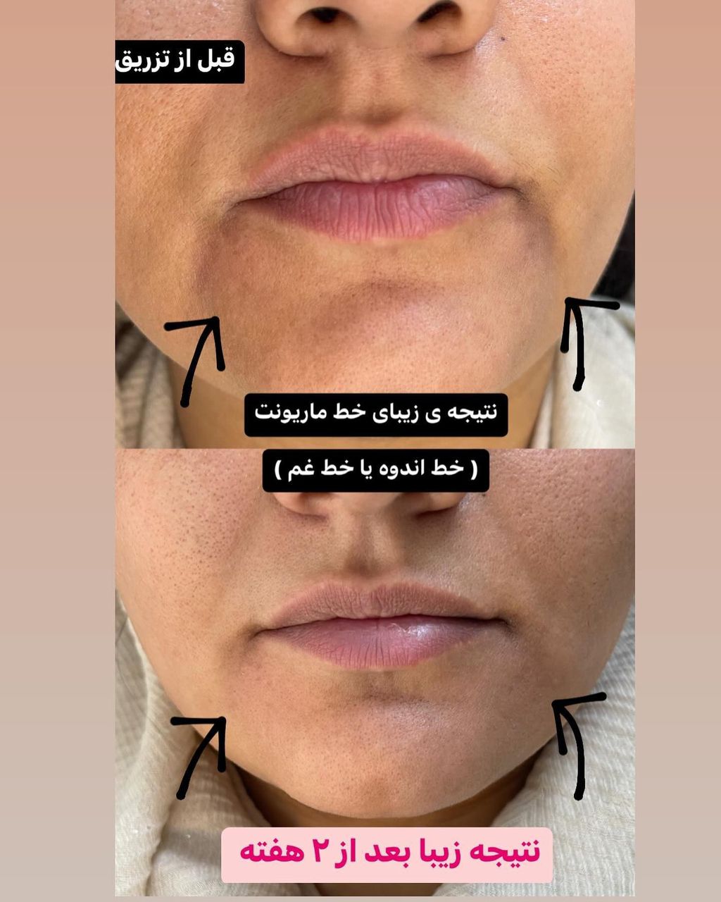 مرکز تخصصی فیلر و بوتاکس نسیم شهر