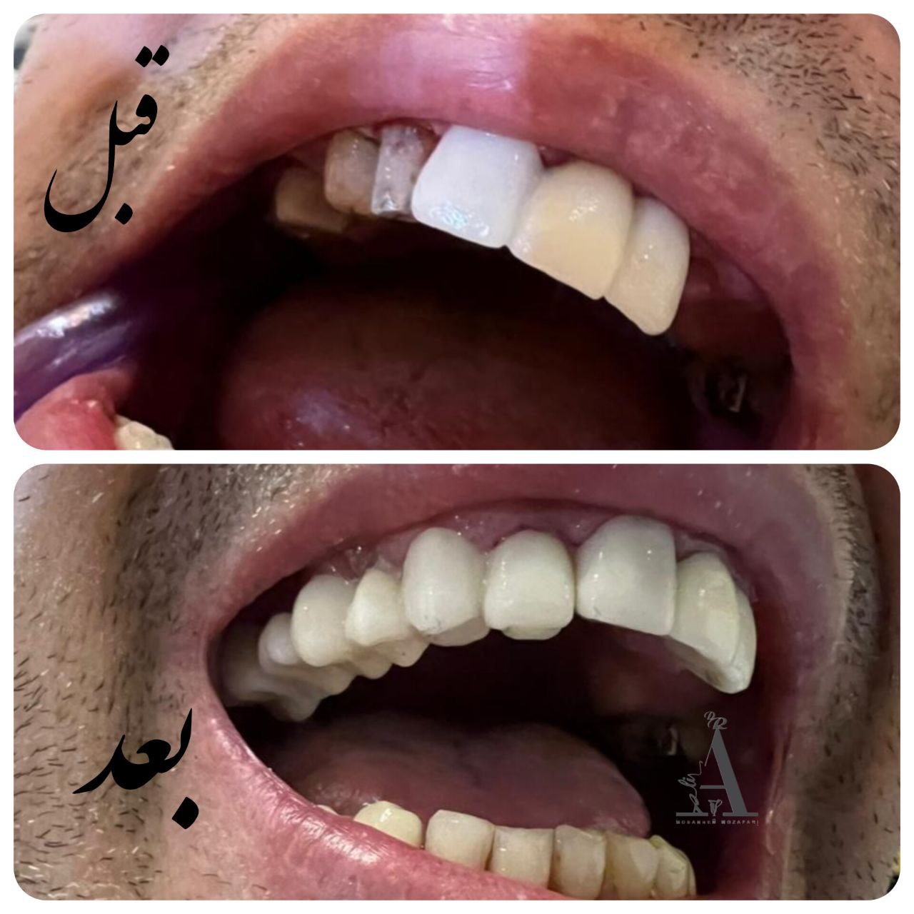 روکش دندان در تهران