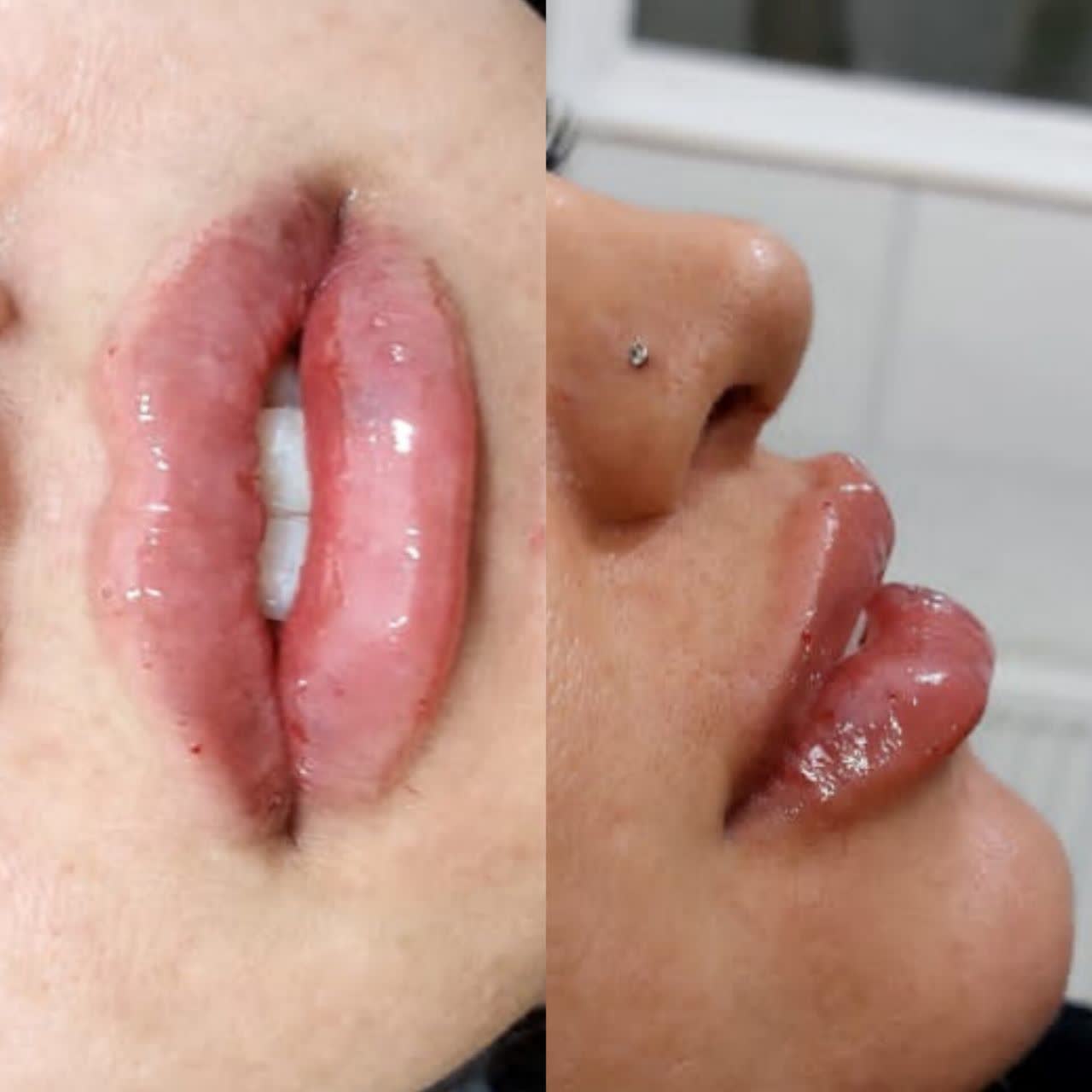 تزریق ژل لب در شاهین شهر