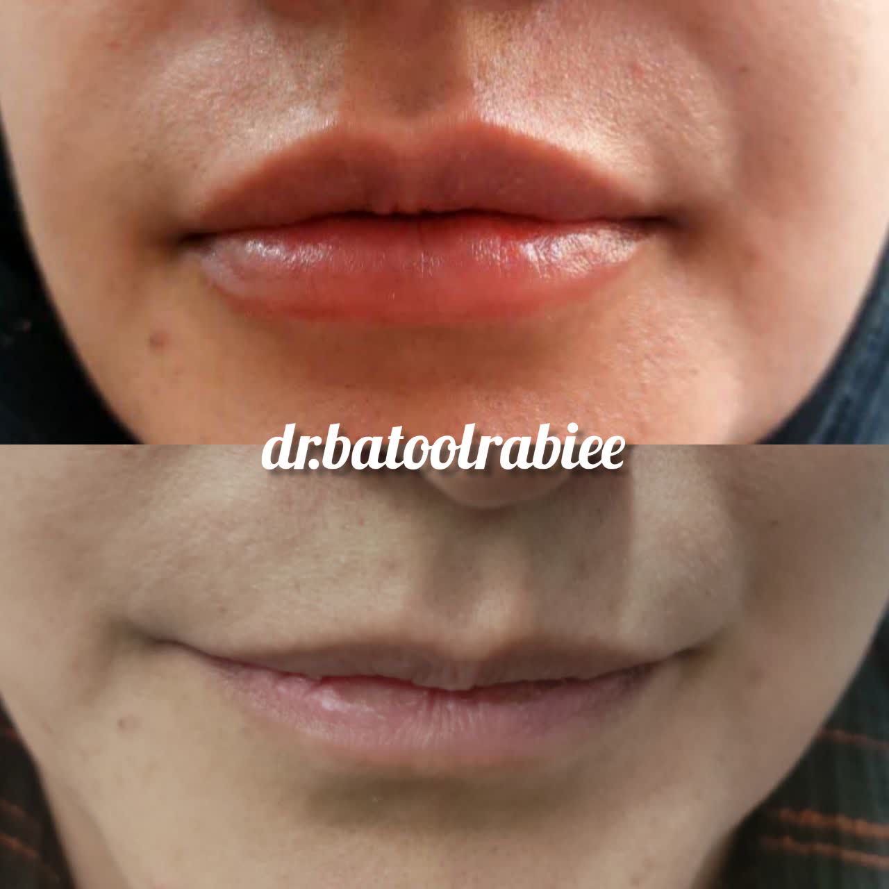 تزریق ژل شاهین شهر