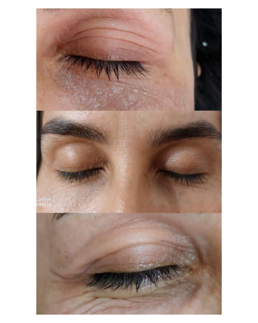 تزریق ژل لب شاهین شهر