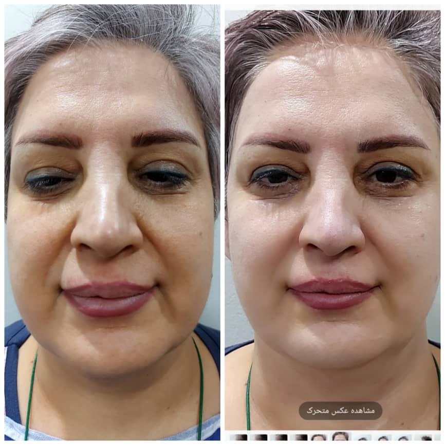 جوانسازی صورت غرب تهران