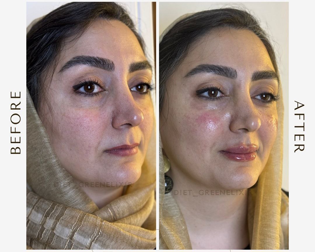 جوانسازی صورت غرب تهران