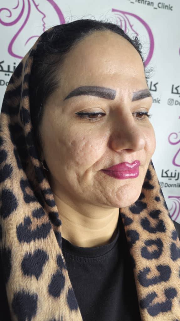 جوانسازی صورت غرب تهران