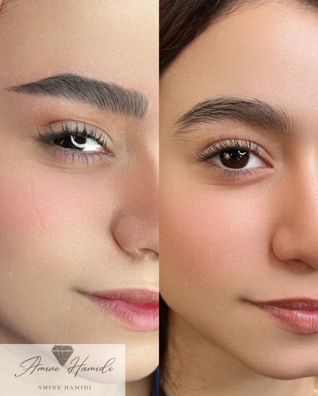 میکرو وپاک کردن تتو درساوه