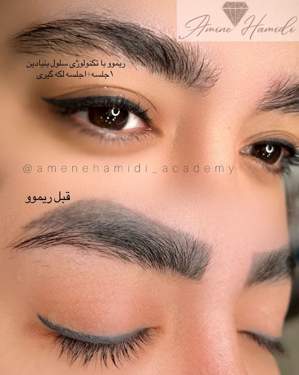 میکرو وپاک کردن تتو درساوه