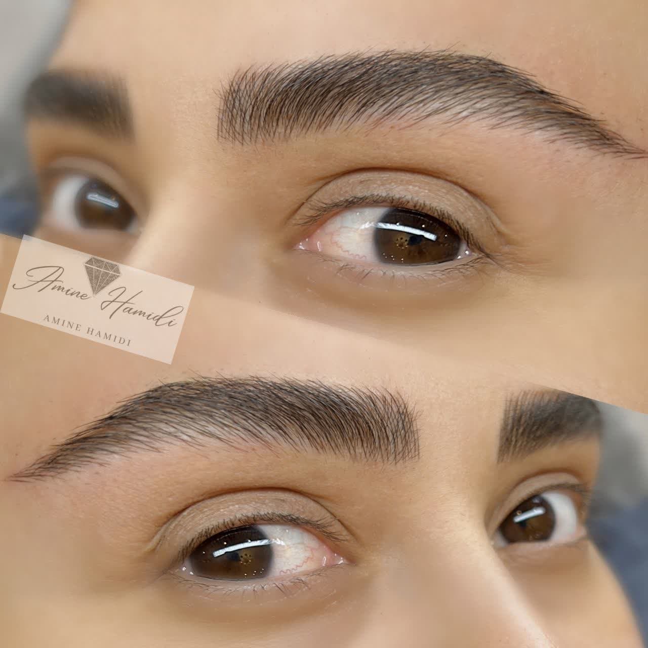 میکرو وپاک کردن تتو درساوه