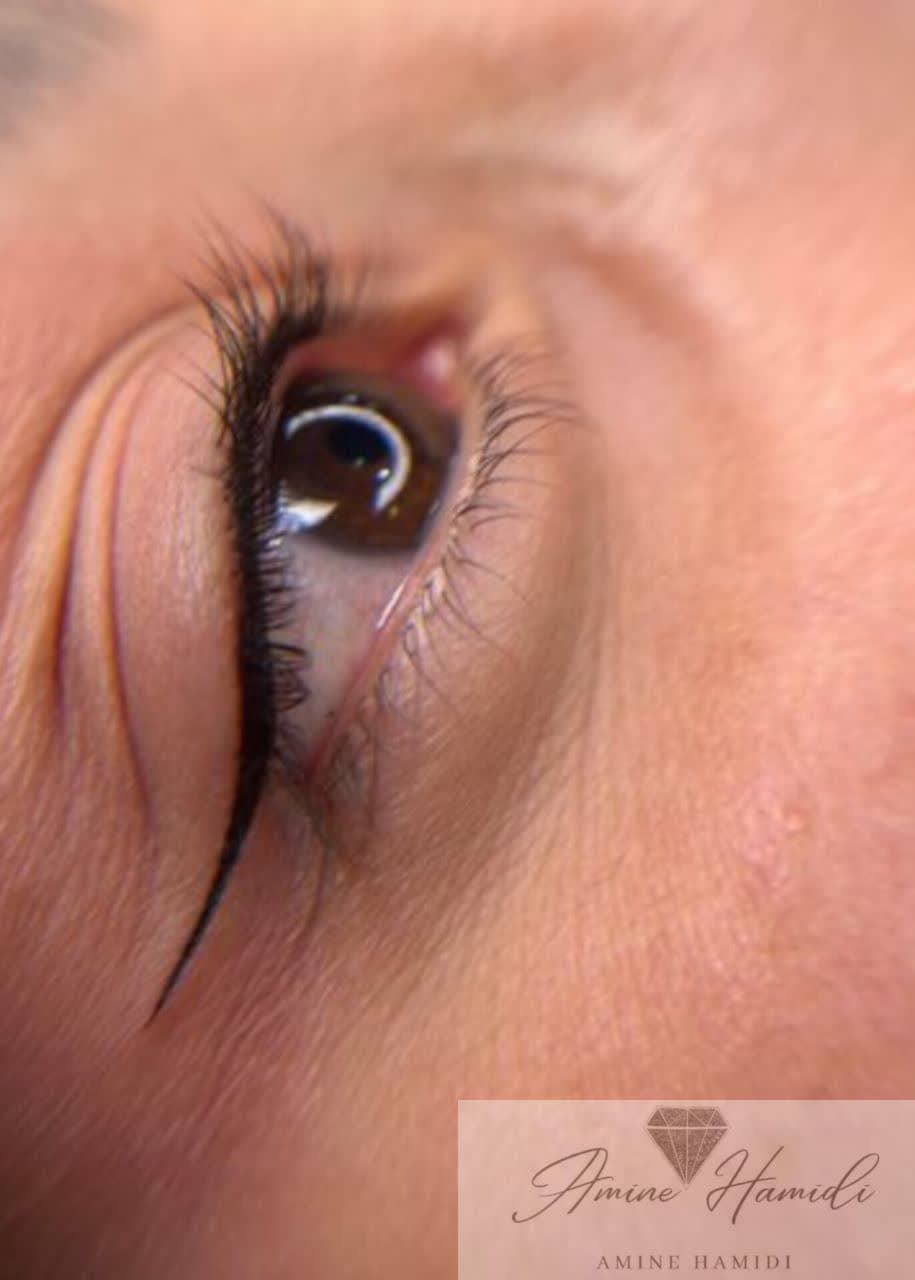 میکرو وپاک کردن تتو درساوه