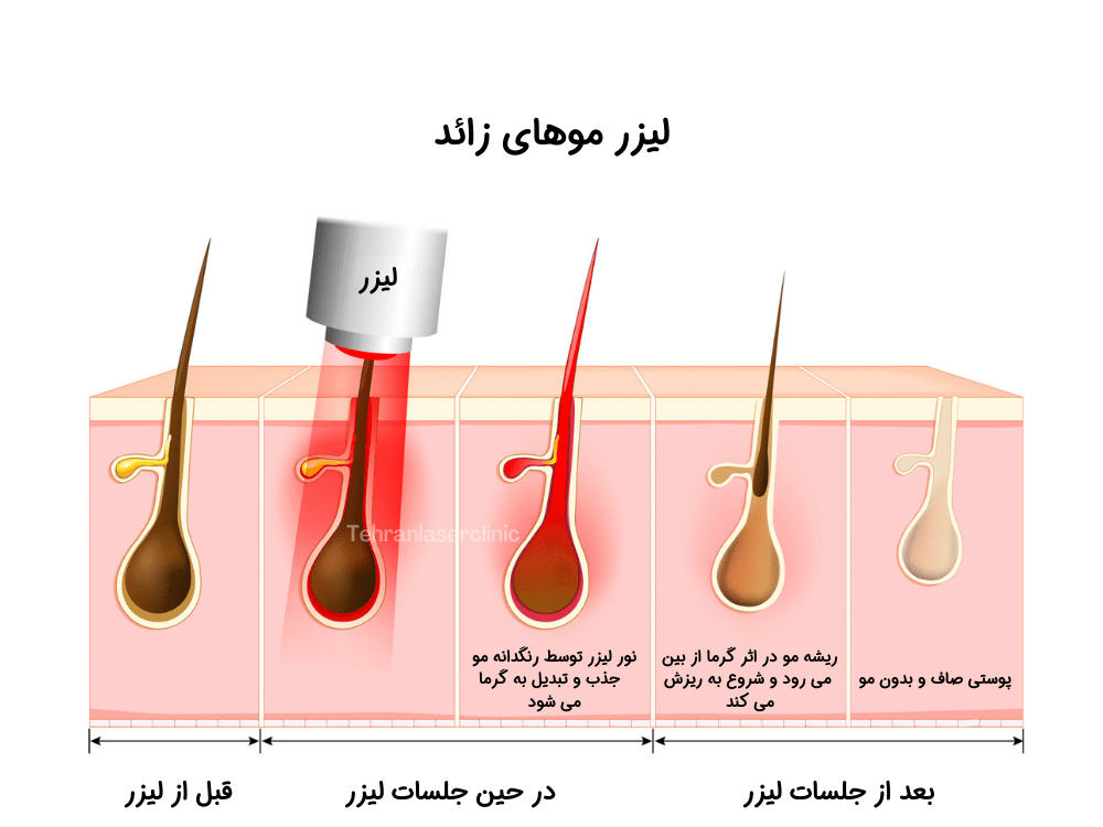 بهترین مرکز لیزر موهای زائد در اهواز