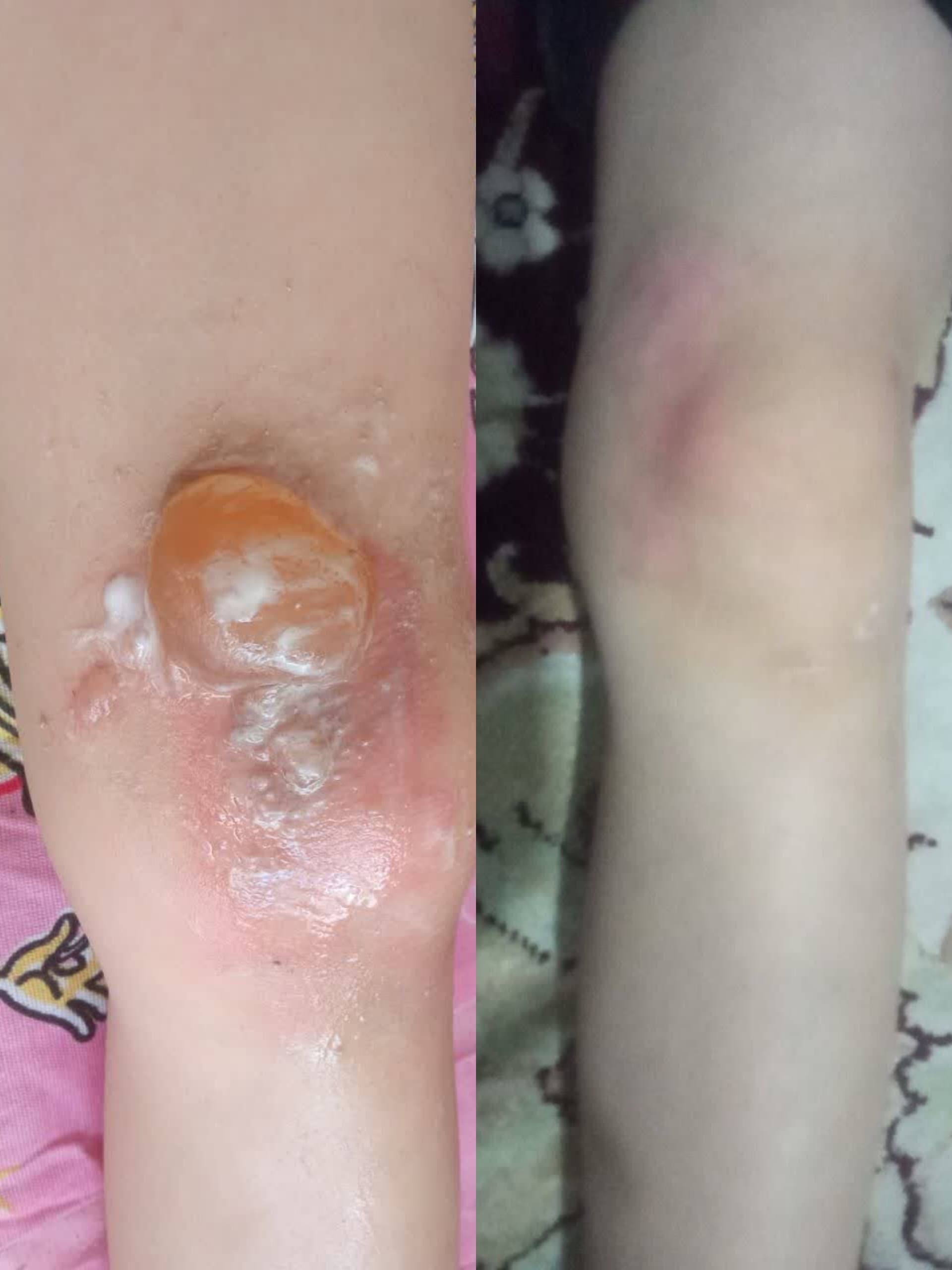 کلینیک زخم در اصفهان