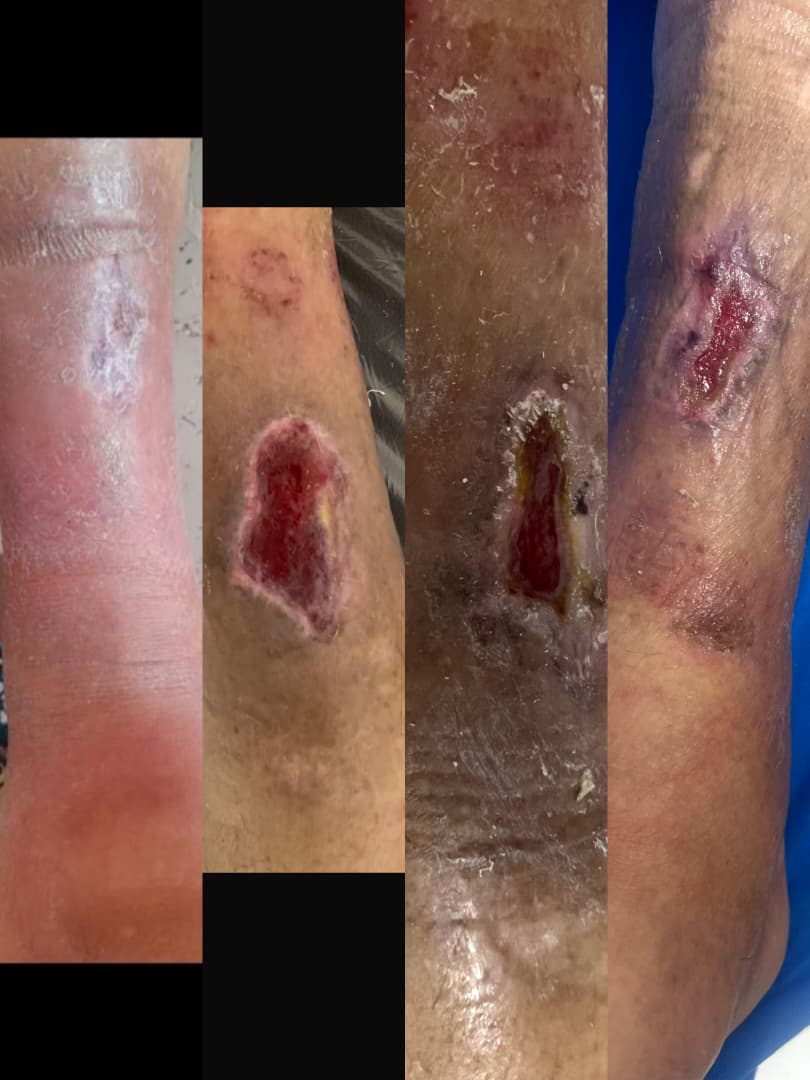 کلینیک زخم در اصفهان