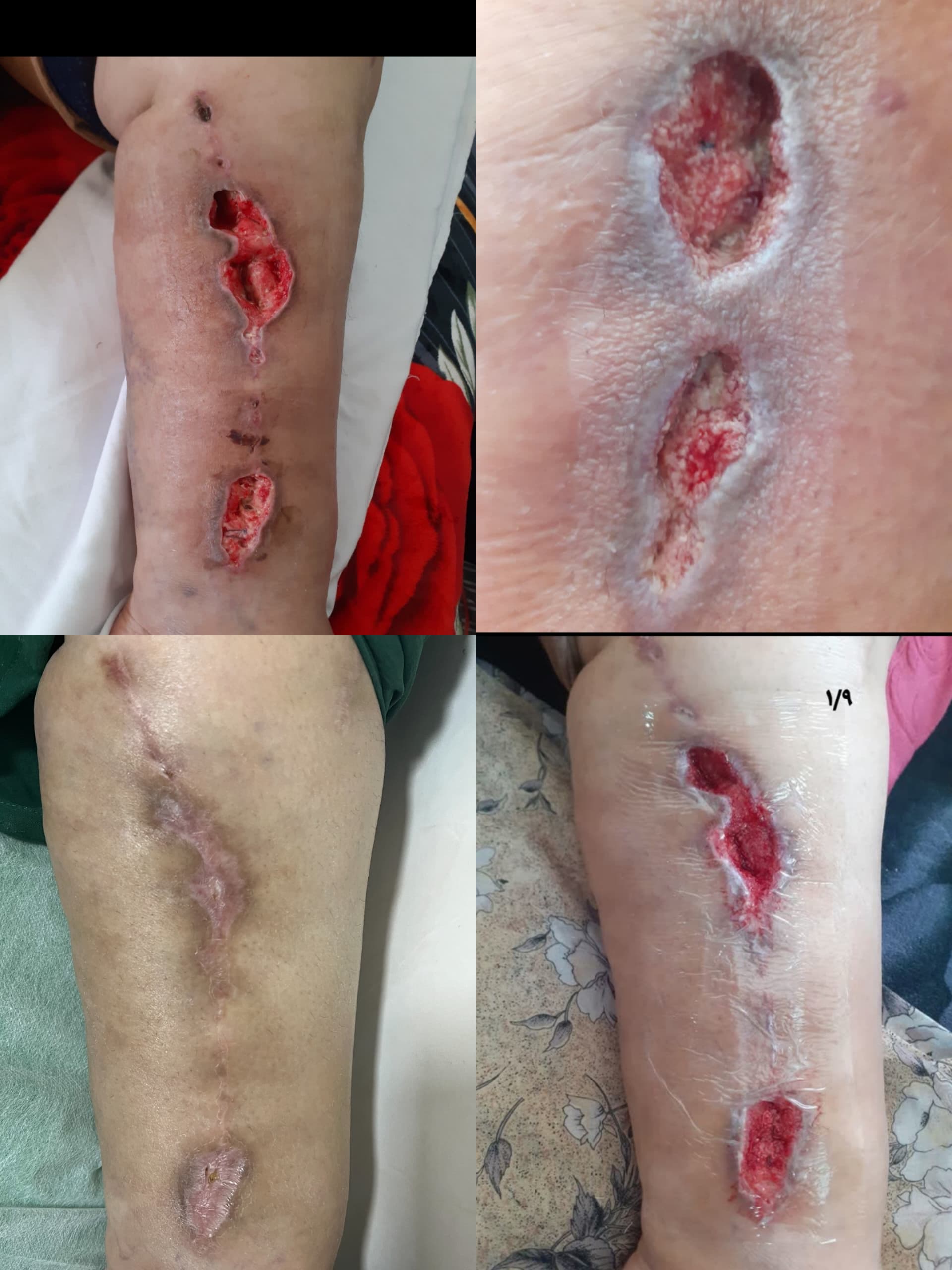 کلینیک زخم در اصفهان