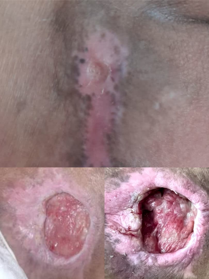 درمان زخم بستر در اصفهان 