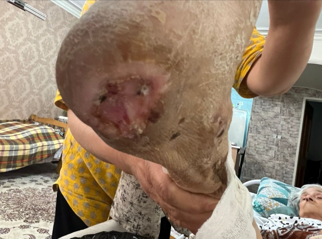 درمان زخم بستر در اصفهان