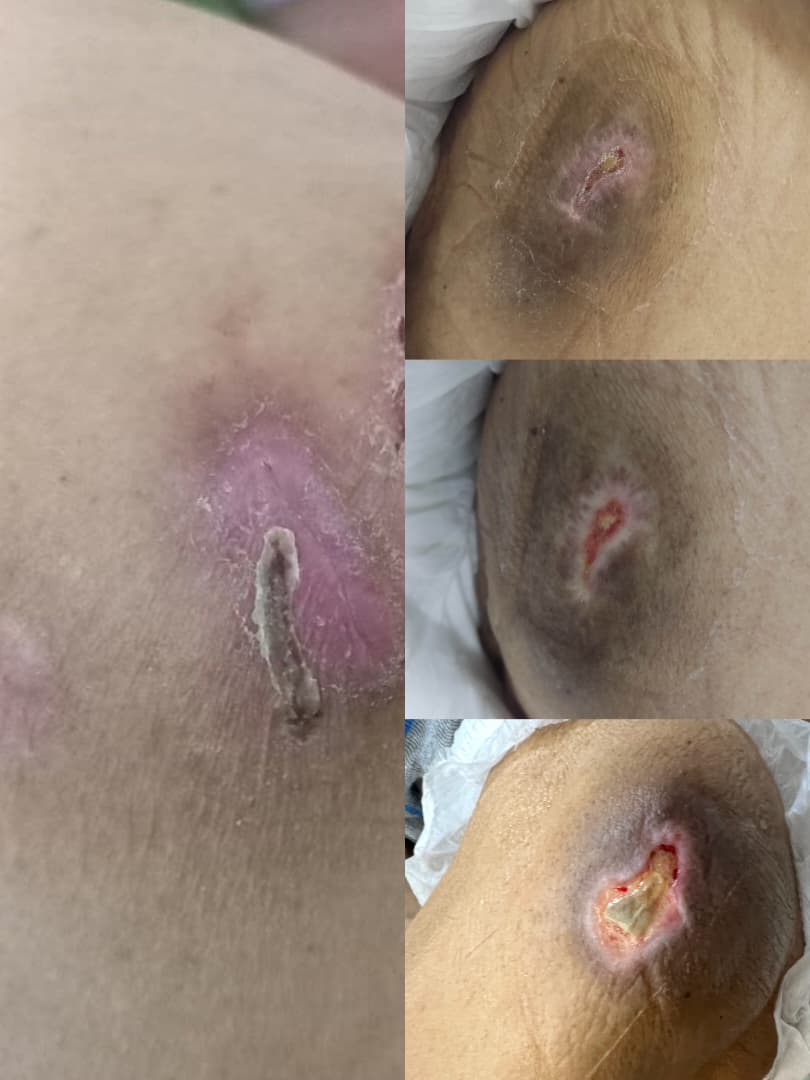 درمان زخم بستر در اصفهان