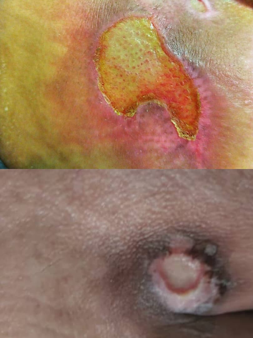 درمان زخم بستر در اصفهان