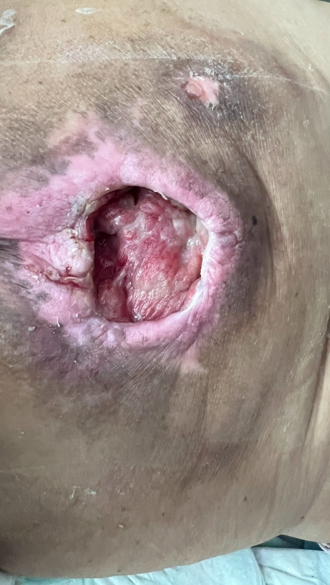 درمان زخم بستر در اصفهان