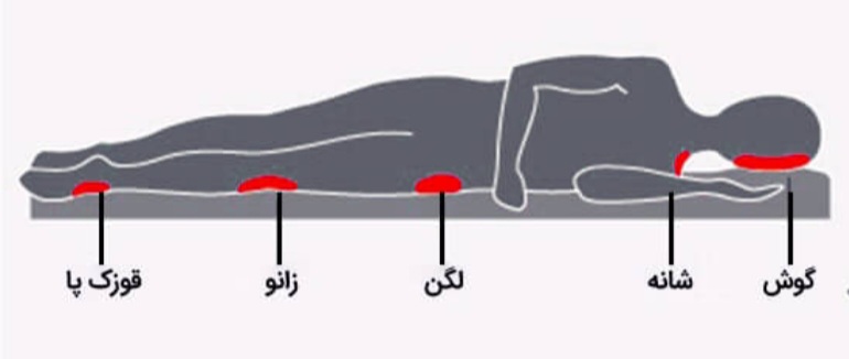 درمان زخم بستر در اصفهان