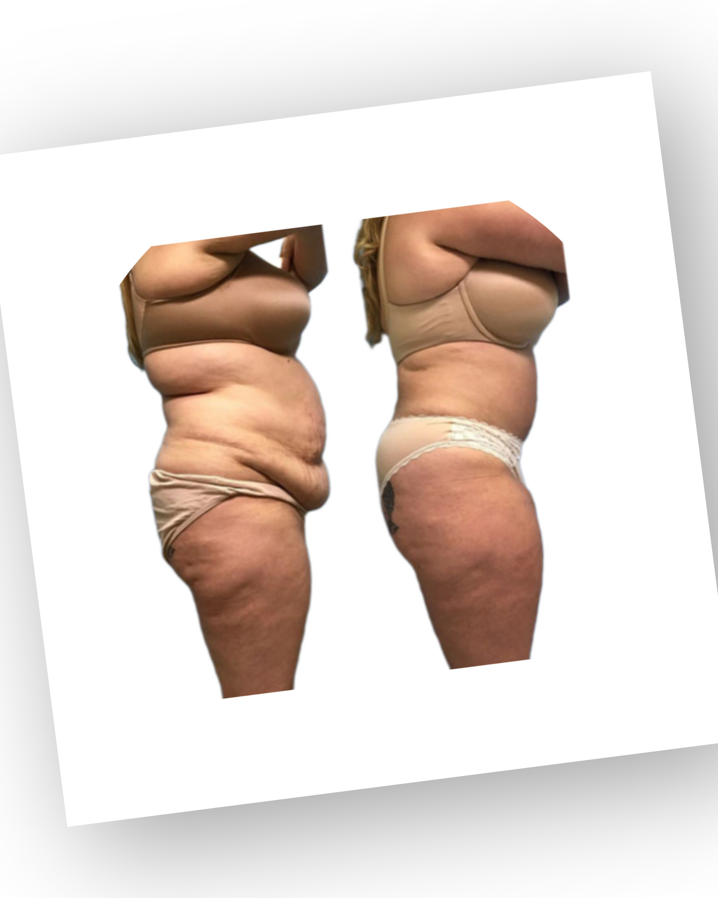 لیپوساکشن در زاهدان