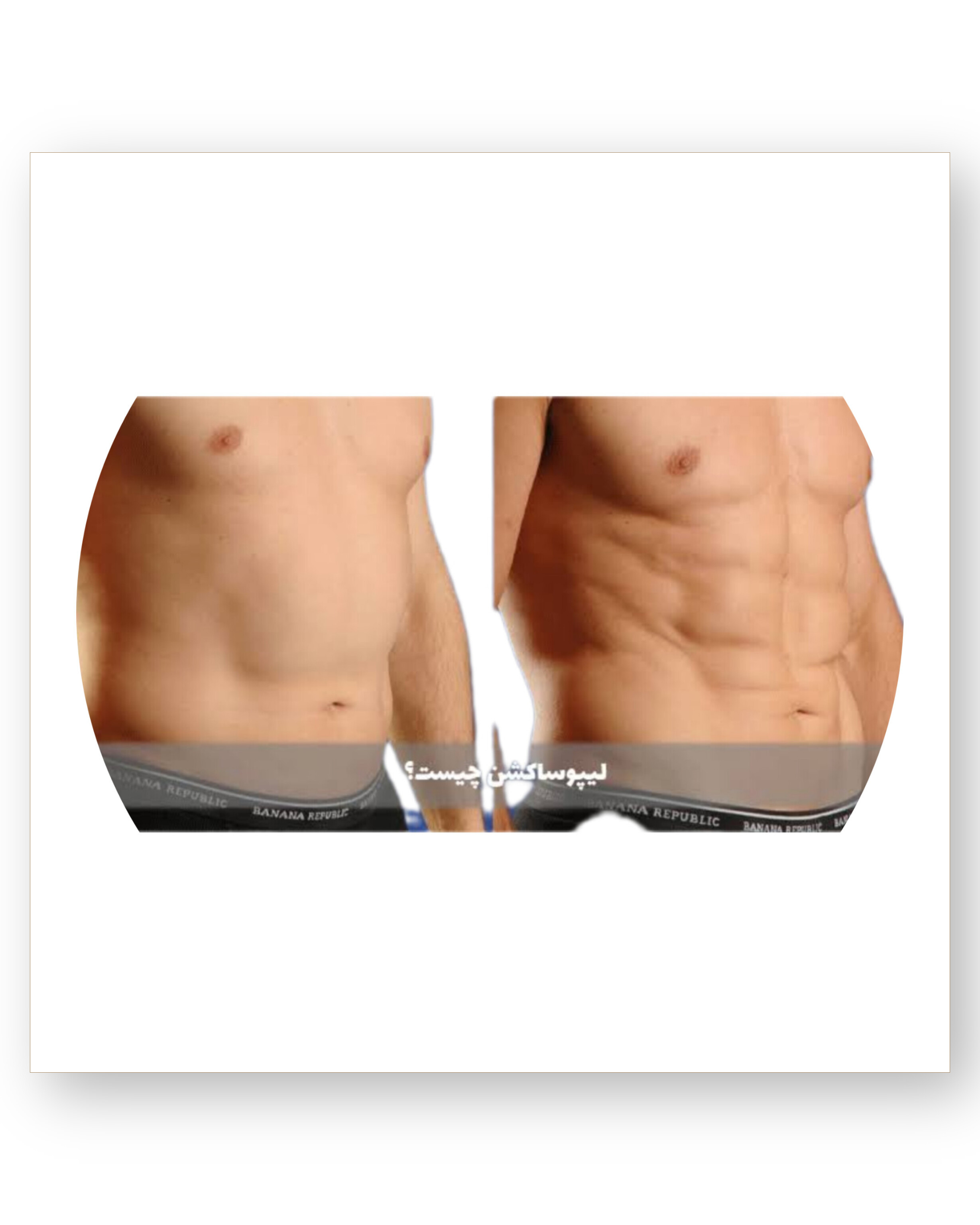 لیپوساکشن در زاهدان