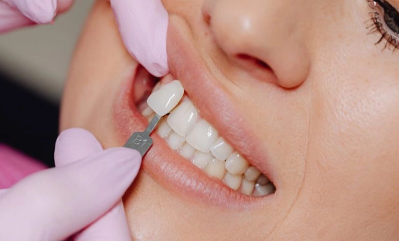 بهترین دندانپزشک زیبایی در شیراز