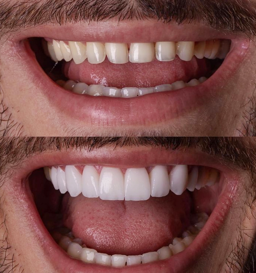 کامپوزیت دندان درشرق تهران  