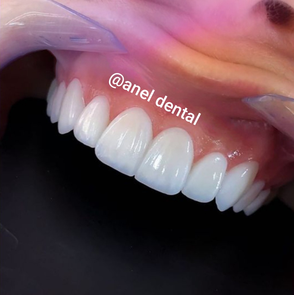 کامپوزیت دندان درشرق تهران  