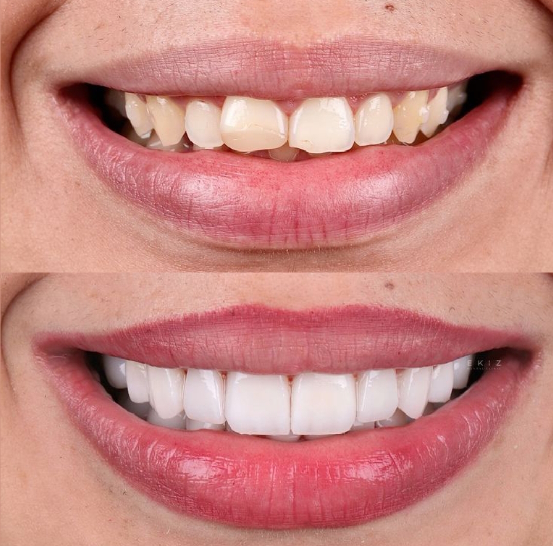 کامپوزیت دندان درشرق تهران  