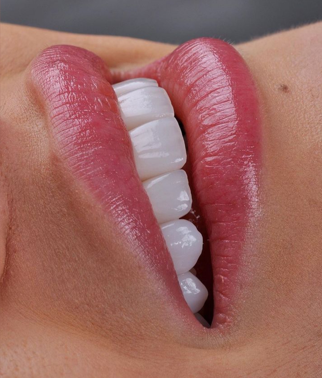 کامپوزیت دندان درشرق تهران  