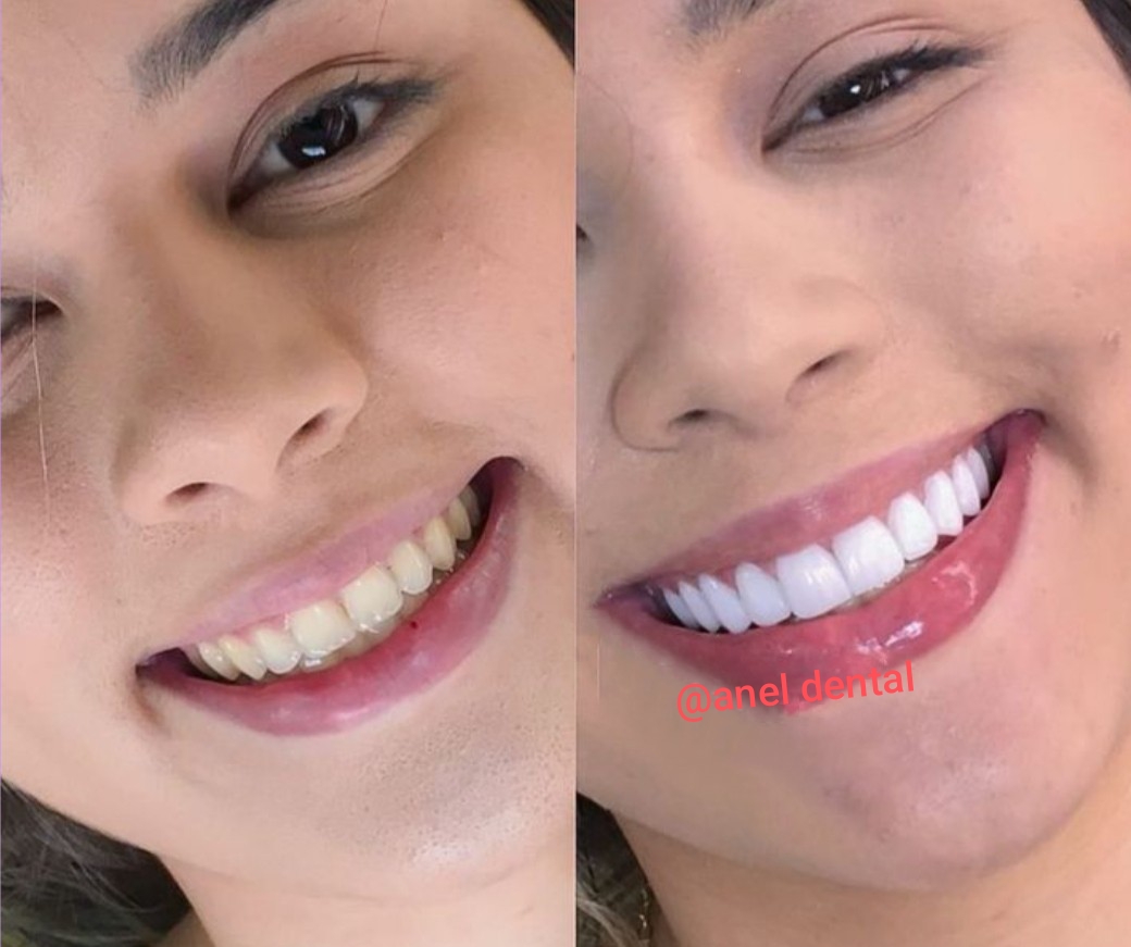 کامپوزیت دندان درشرق تهران  