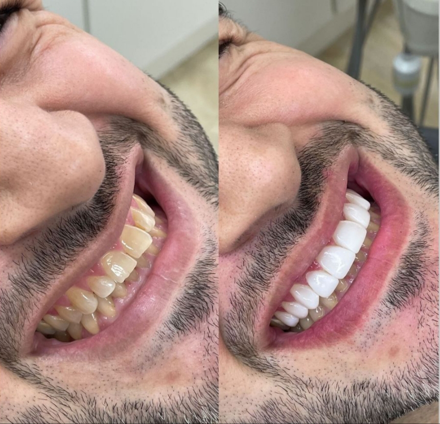 کامپوزیت دندان درشرق تهران  