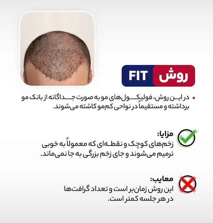 بهترین دکتر کاشت مو در ارومیه