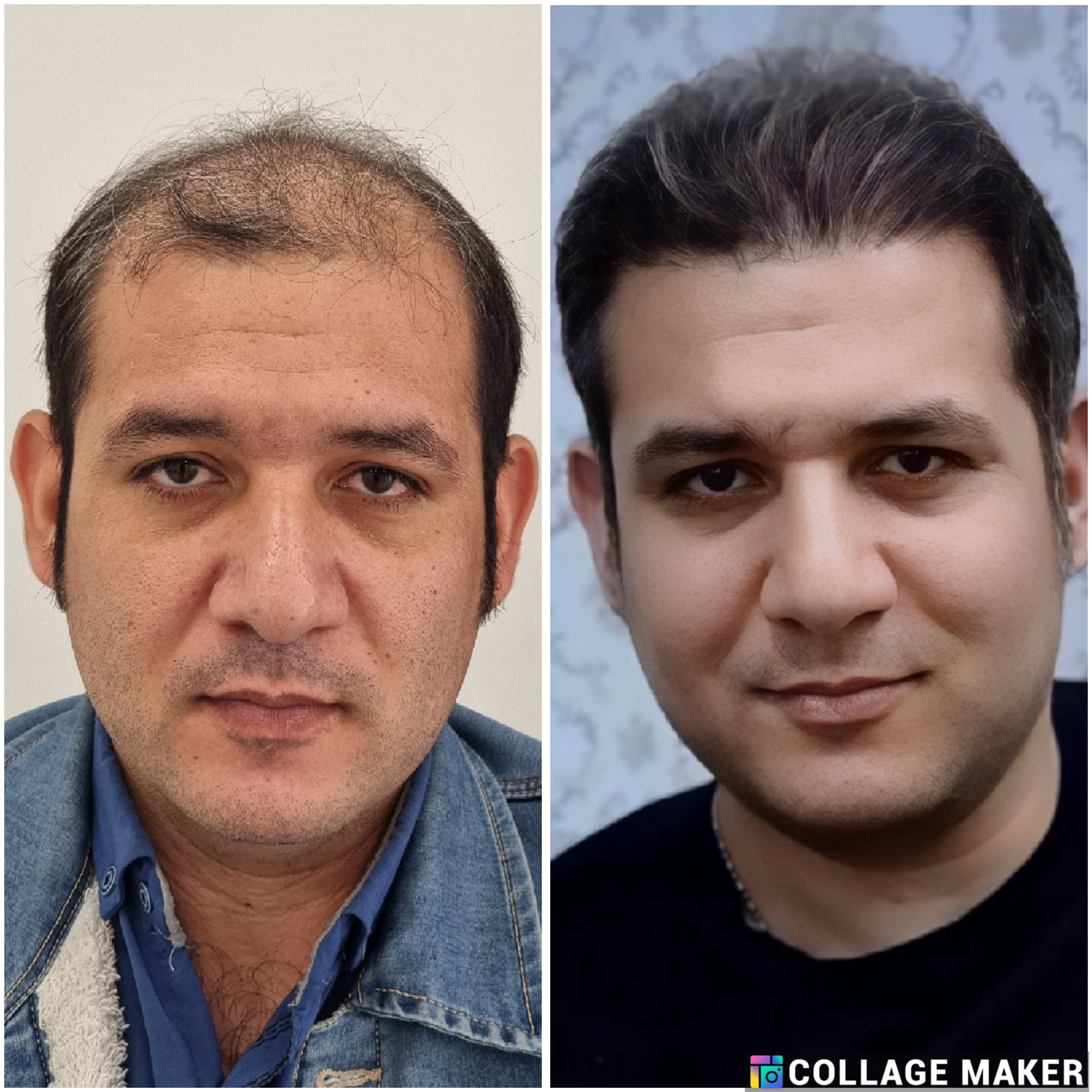 خدمات کاشت مو یزد