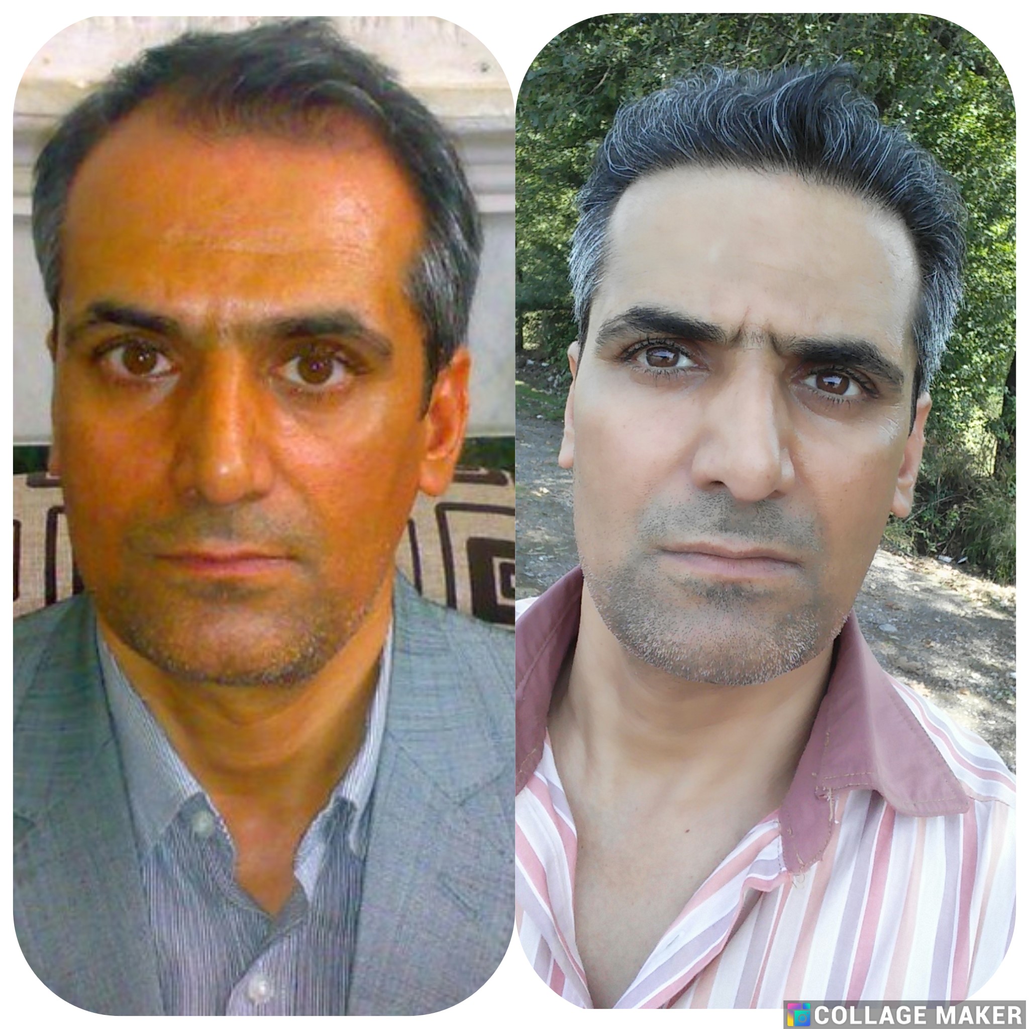 خدمات کاشت مو یزد