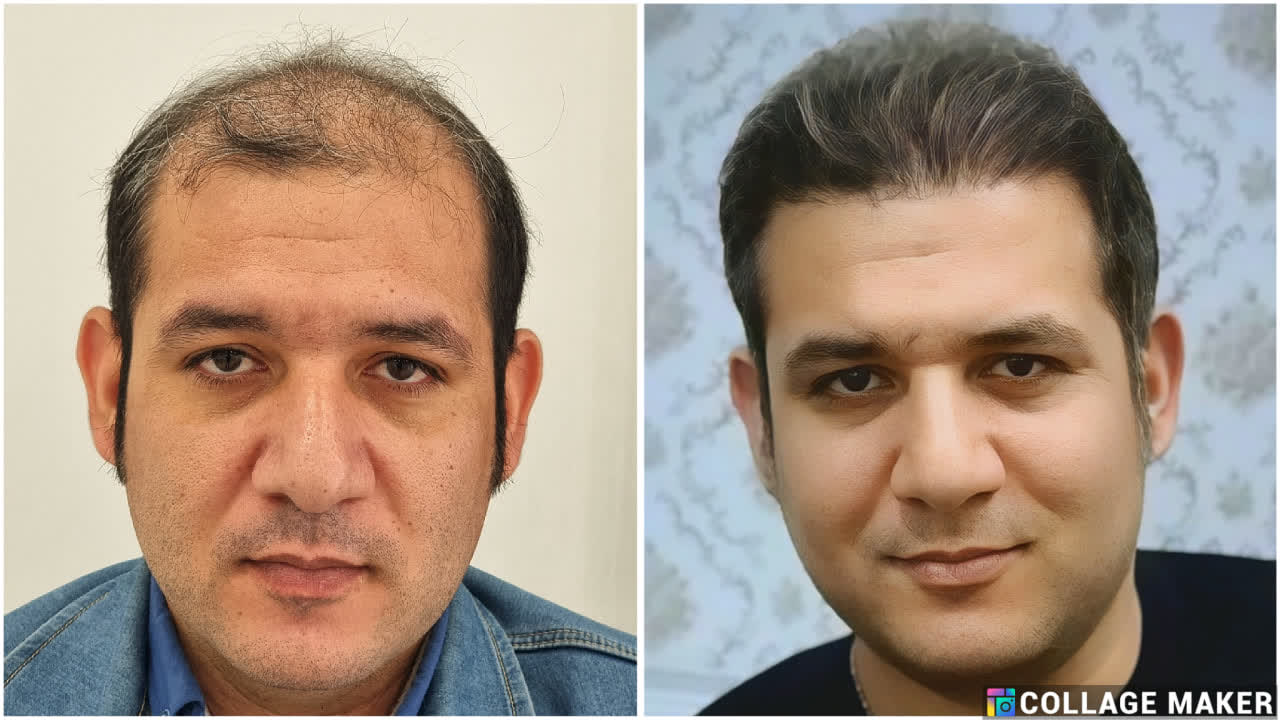 خدمات کاشت مو یزد