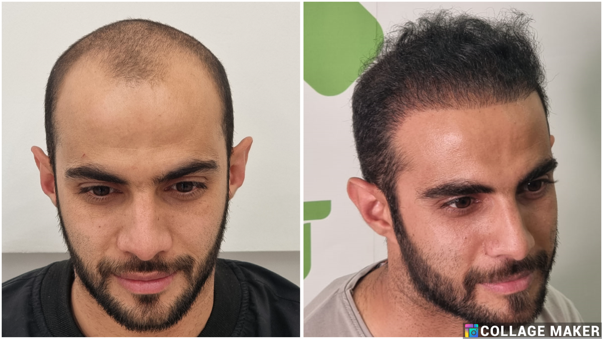خدمات کاشت مو یزد