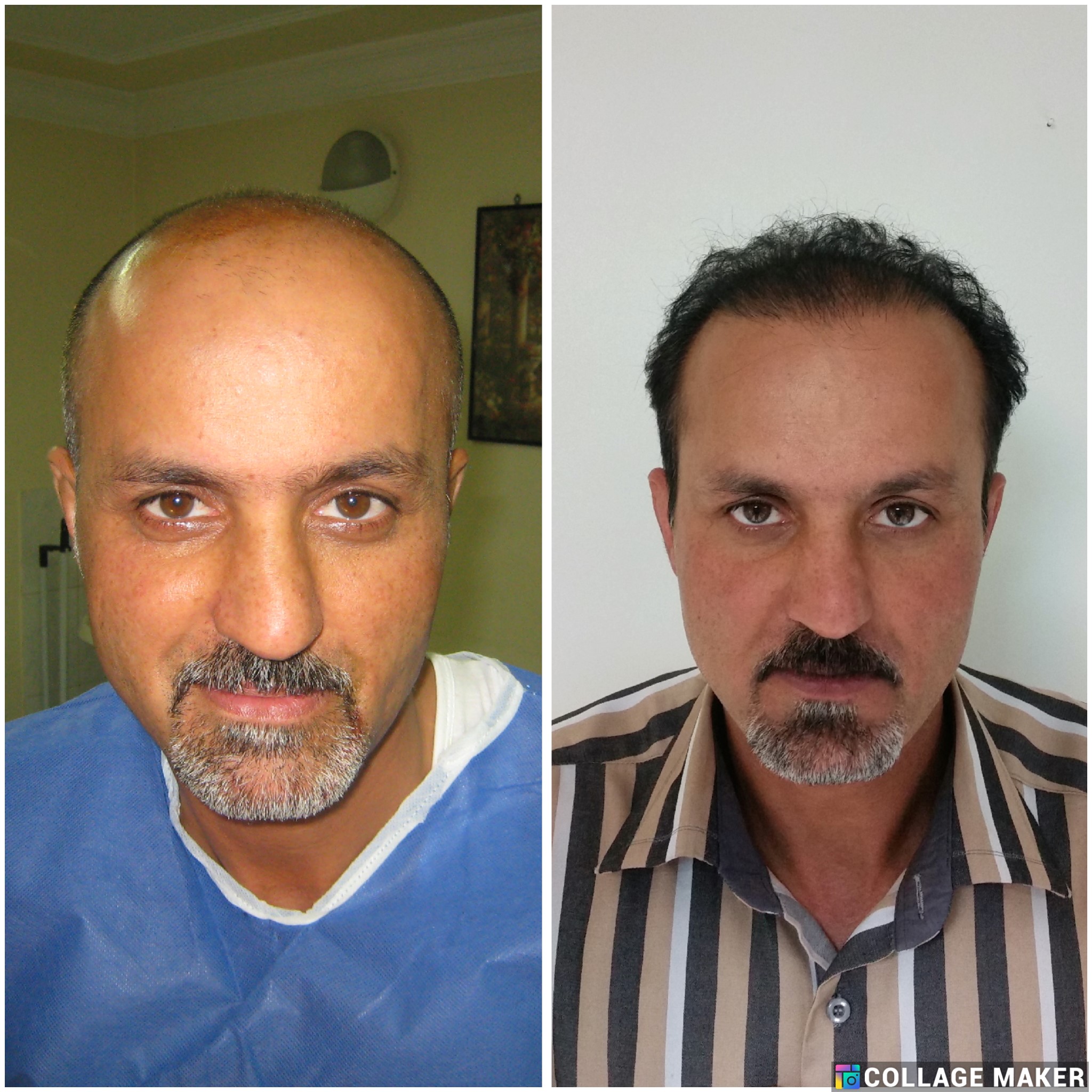 خدمات کاشت مو یزد