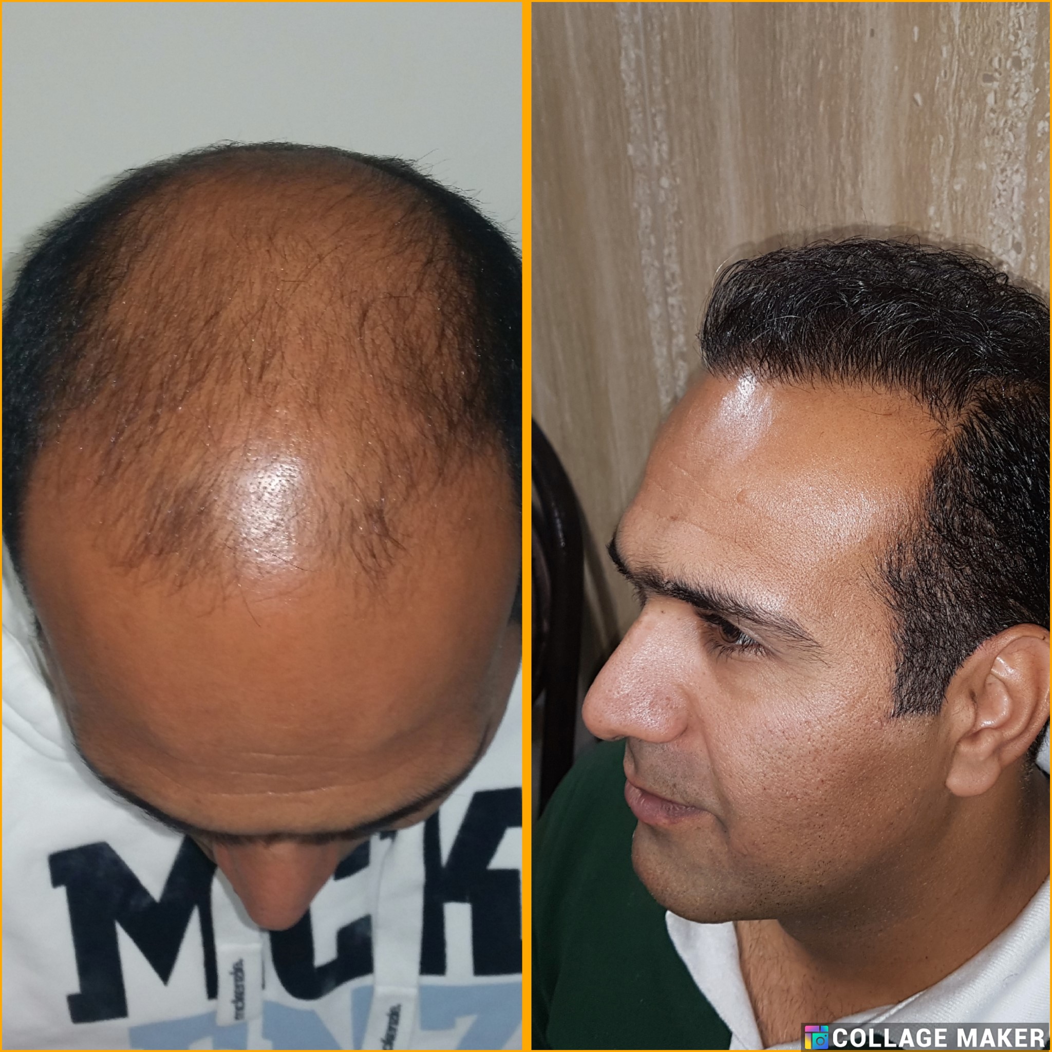 خدمات کاشت مو یزد