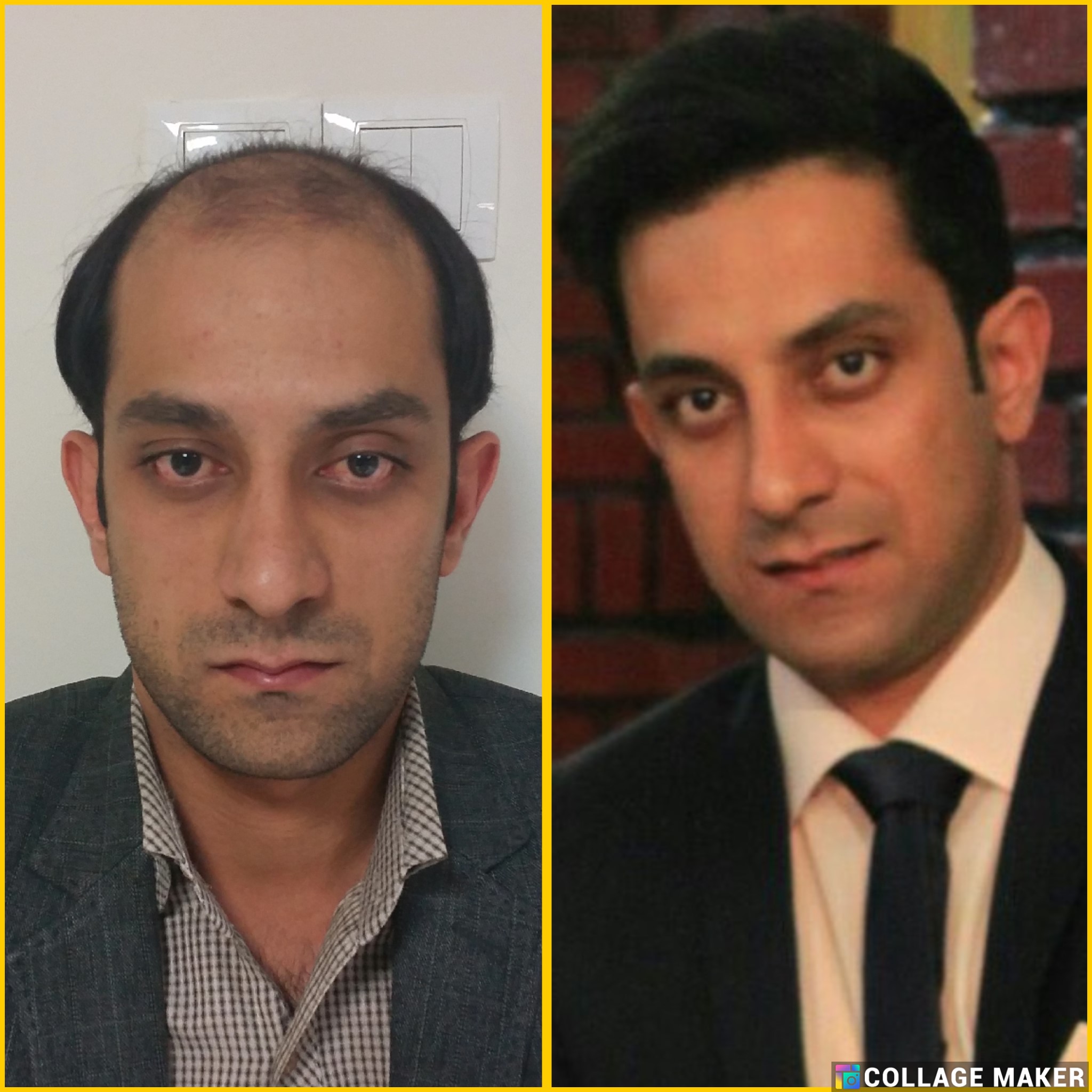 خدمات کاشت مو یزد