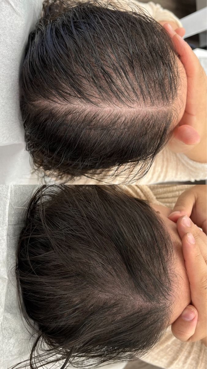 کلینیک کاشت مو یزد