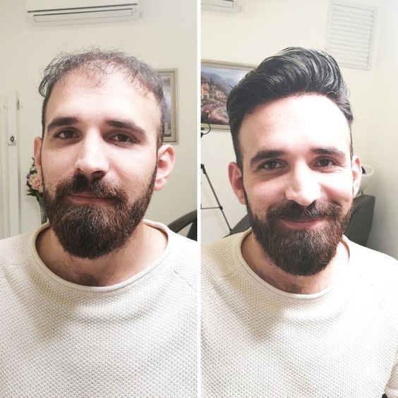 کلینیک کاشت مو یزد