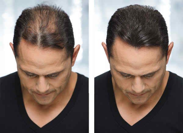 کلینیک کاشت مو یزد