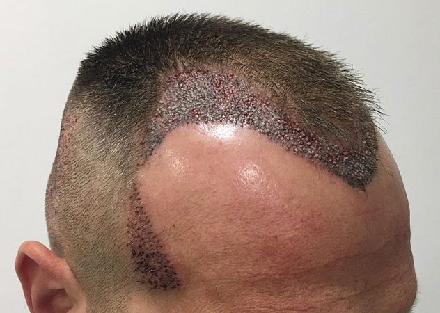 کلینیک کاشت مو یزد