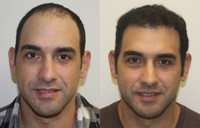 کلینیک کاشت مو در یزد