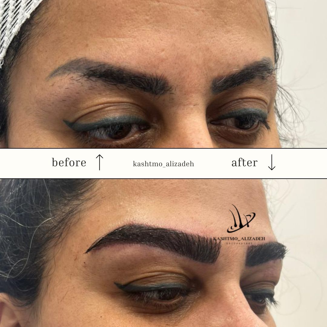 هزینه کاشت ابرو در ارومیه