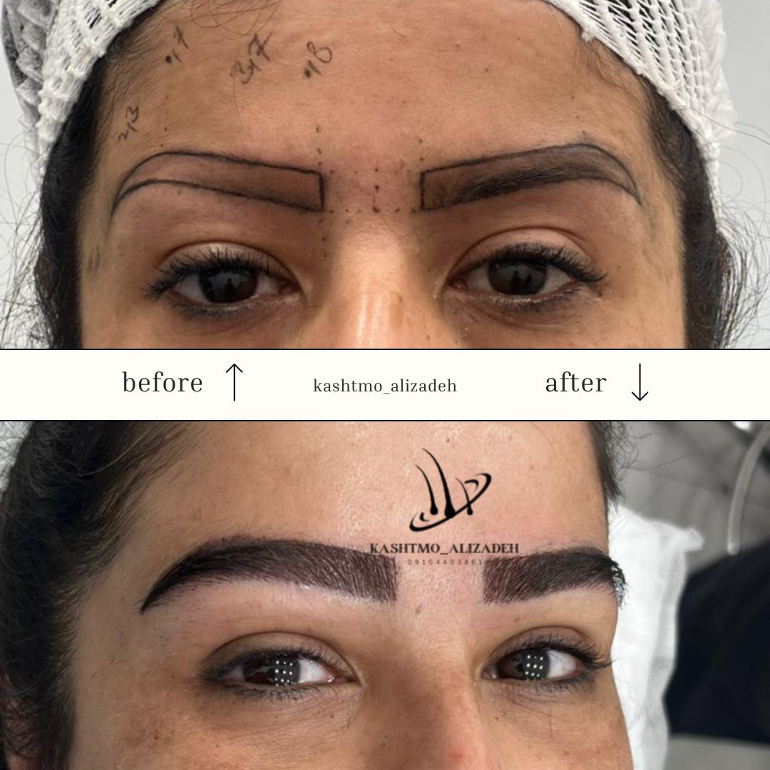 هزینه کاشت ابرو در ارومیه