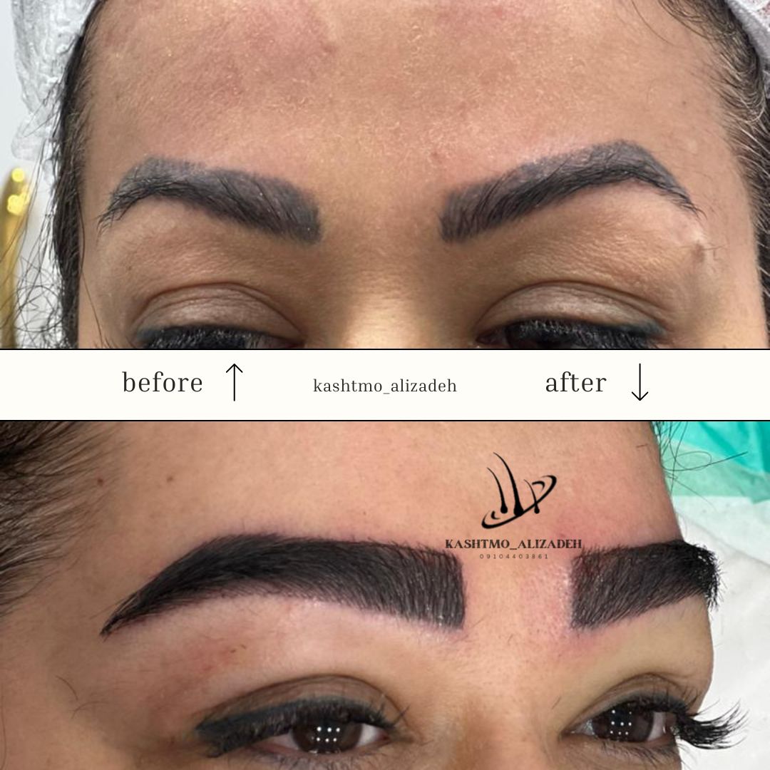 بهترین دکتر کاشت ابرو در ارومیه
