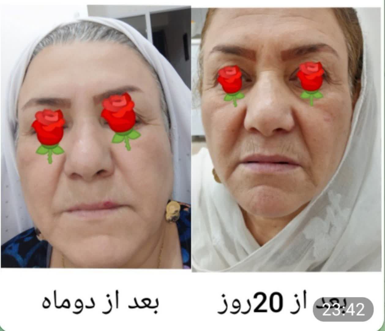 بمب 💥💥💥💥
#رضایت مشتری عزیز 😍😍
استفاده از محصولات #روتین
سرم طلا
فوق آبرسان
کلاژن
قطره زینک و سلیس