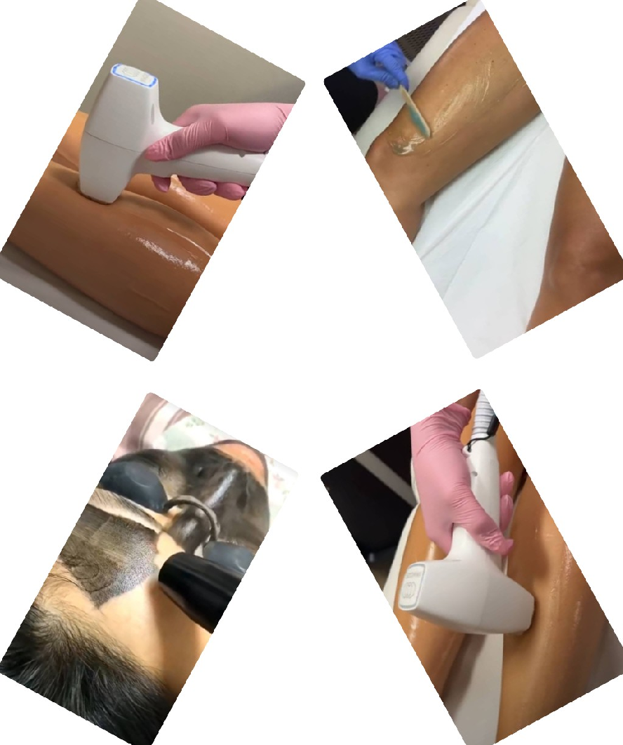 لیزر موهای زائد در اصفهان 